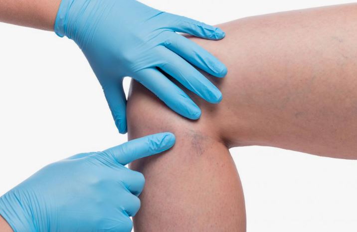 sclerotherapy billing