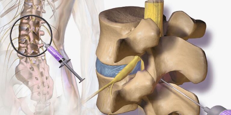 X-ray Guided Facet Injections Billing Guide for Accurate Reimbursement ...